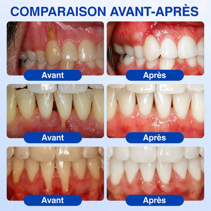 🇫🇷 𝑮𝒍𝒊𝒎𝒎𝒆𝒓𝒍𝒚®🦷 𝑮𝒖𝒎𝑹𝒆𝒗𝒊𝒗𝒆 𝑮𝒆𝒍 𝒅𝒆 𝑹é𝒑𝒂𝒓𝒂𝒕𝒊𝒐𝒏 𝑷𝒂𝒓𝒐𝒅𝒐𝒏𝒕𝒂𝒍𝒆🌈