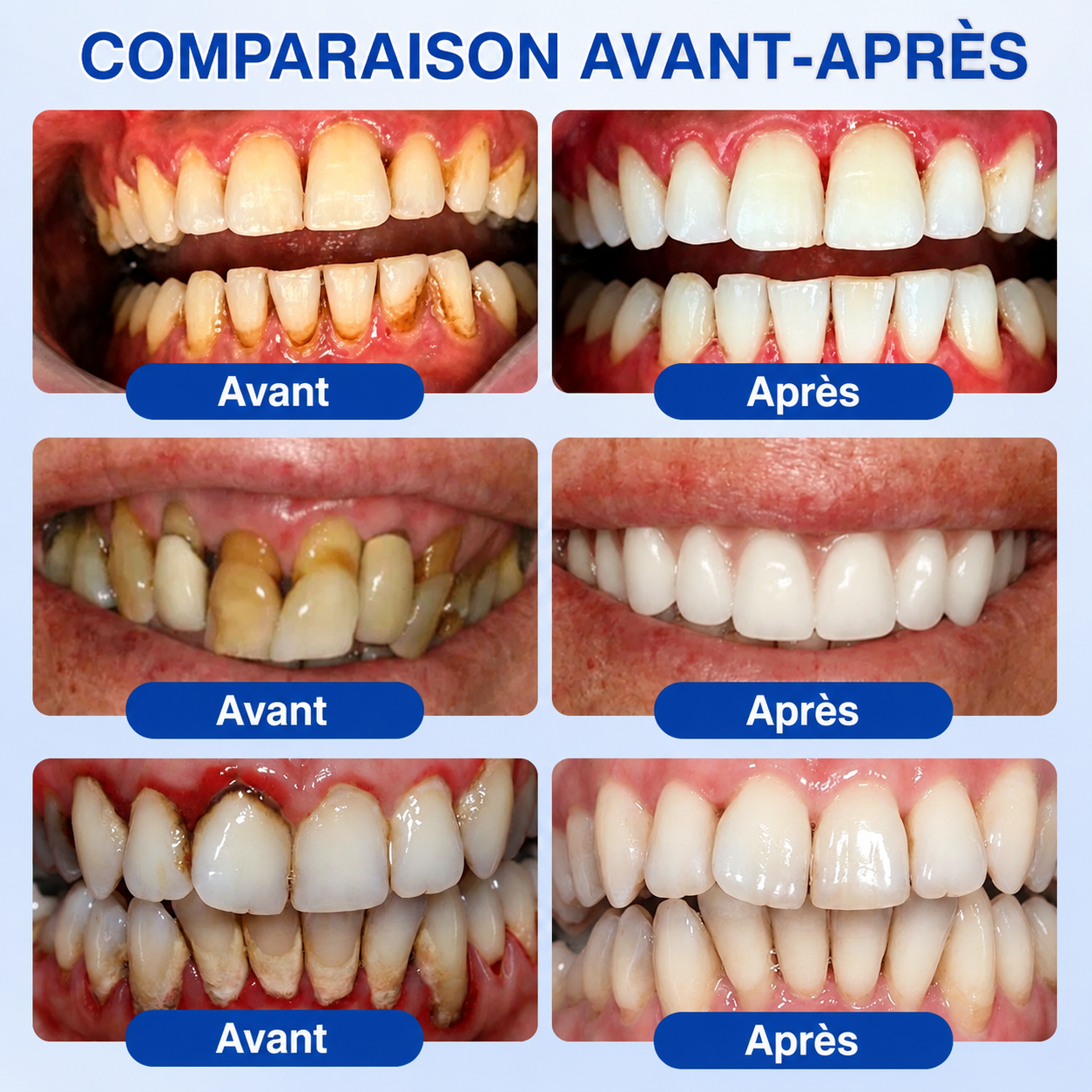 🇫🇷 𝑮𝒍𝒊𝒎𝒎𝒆𝒓𝒍𝒚®🦷 𝑮𝒖𝒎𝑹𝒆𝒗𝒊𝒗𝒆 𝑮𝒆𝒍 𝒅𝒆 𝑹é𝒑𝒂𝒓𝒂𝒕𝒊𝒐𝒏 𝑷𝒂𝒓𝒐𝒅𝒐𝒏𝒕𝒂𝒍𝒆🌈